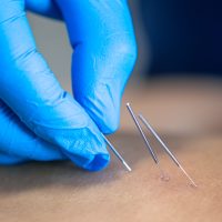 Acupuncture traditionelle