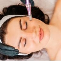 microneedling